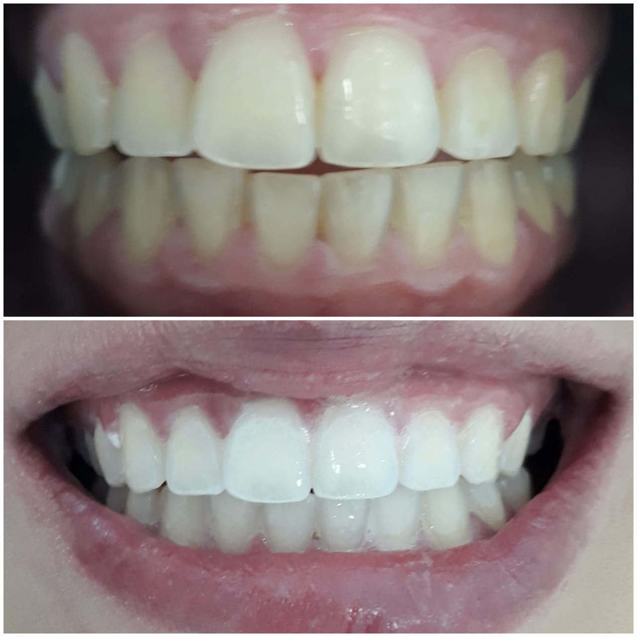 Antes e depois - Clareamento Dental Profissional