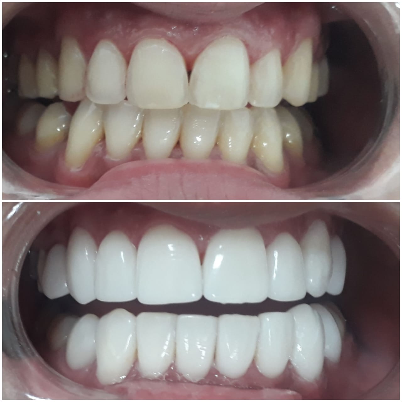 Antes e depois - Facetas de Porcelana