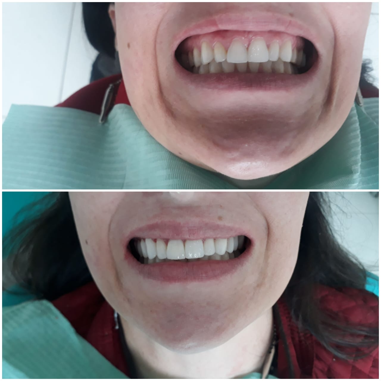 Antes e depois - Facetas de Resina