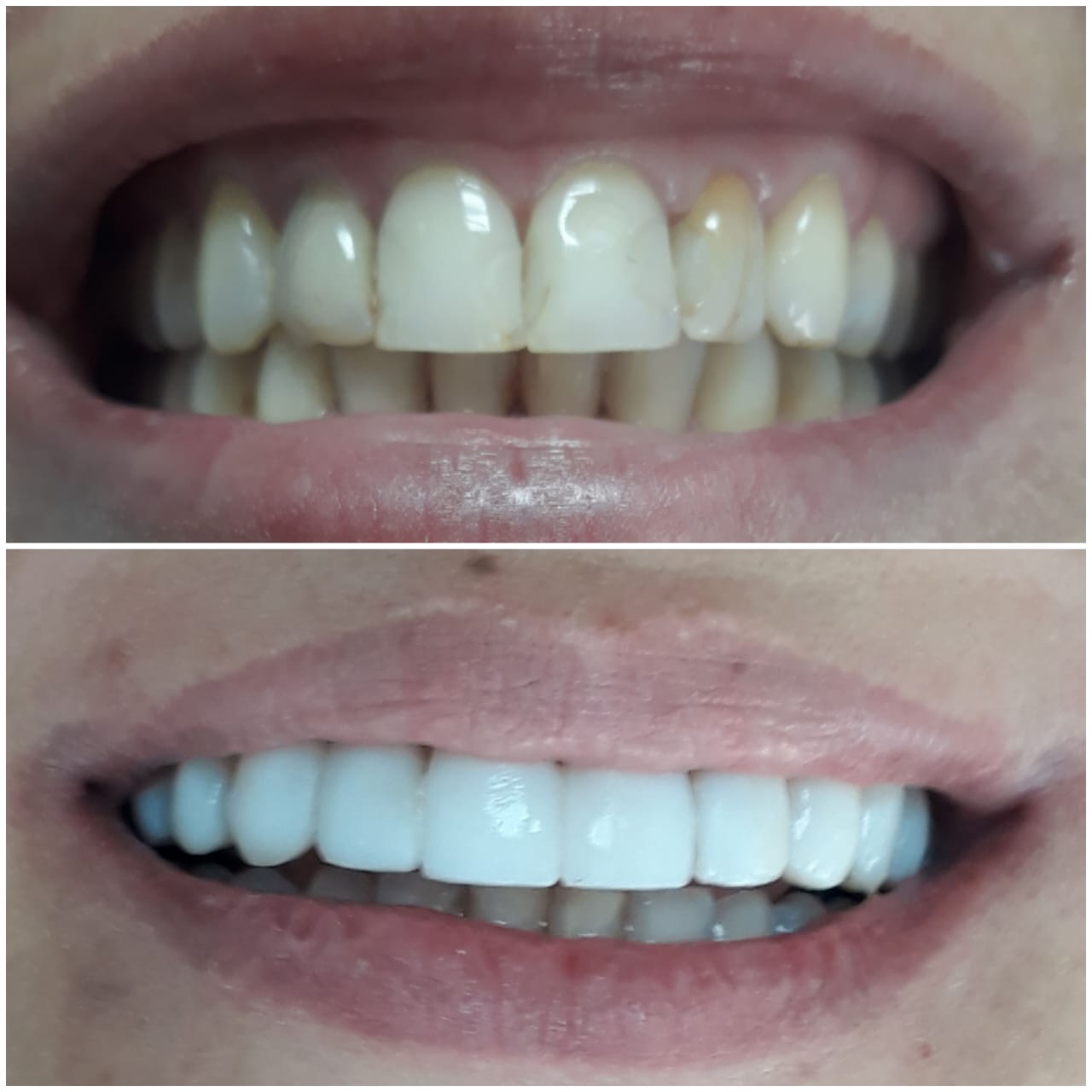 Antes e depois - Facetas de Resina