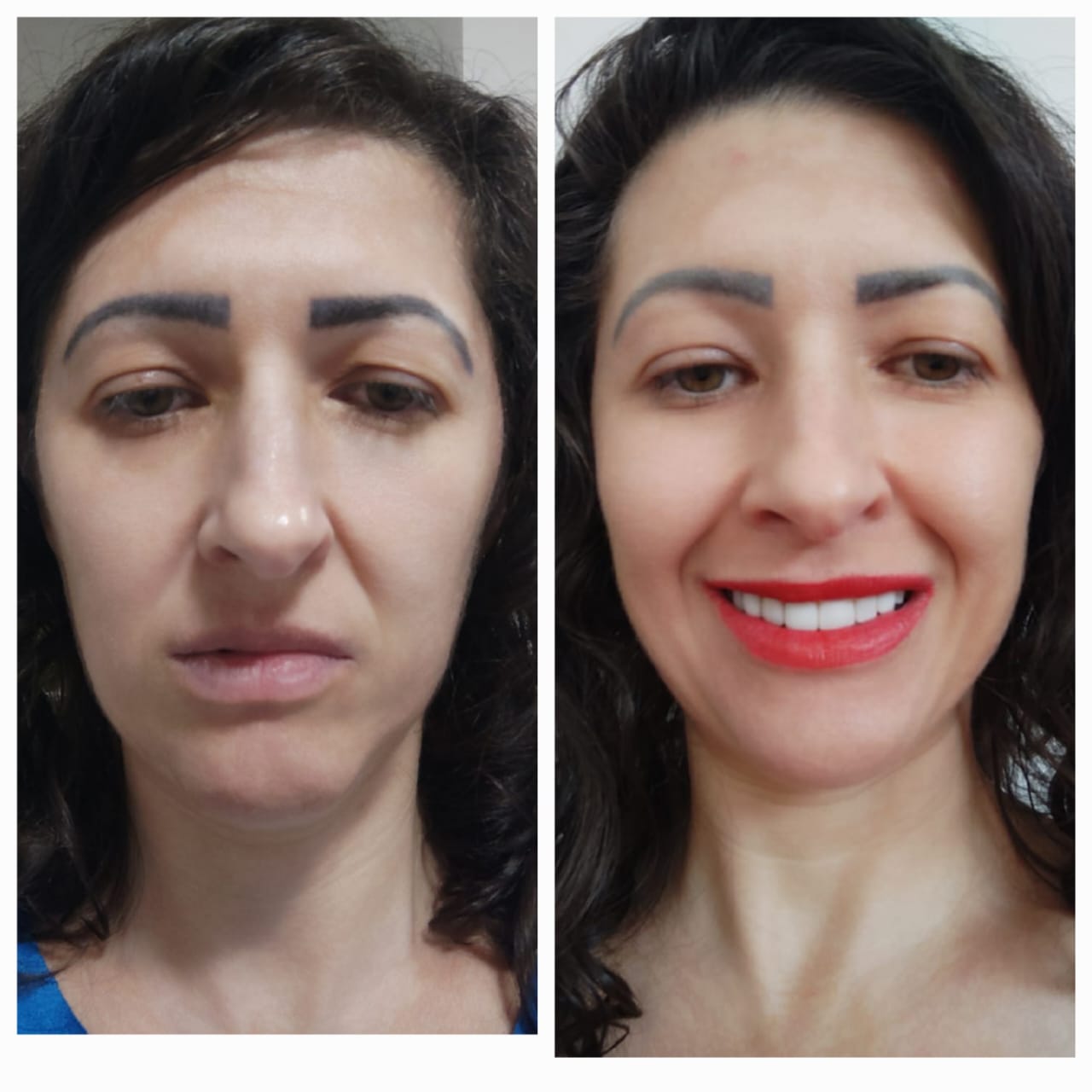 Antes e depois - Harmonização Orofacial