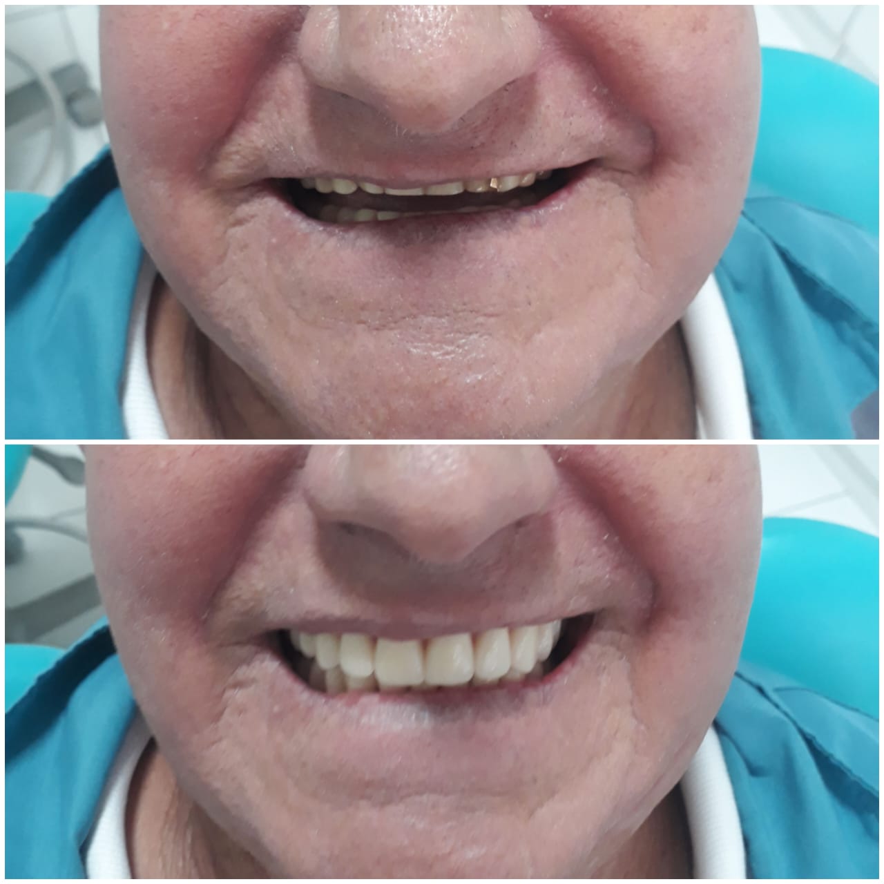 Antes e depois - Protocolo Fixa Sobre-Implantes